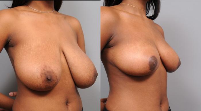 Before & After Breast Reduction Case 108 View #4 View in New York, NY