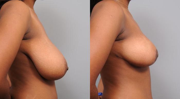 Before & After Breast Reduction Case 108 View #5 View in New York, NY