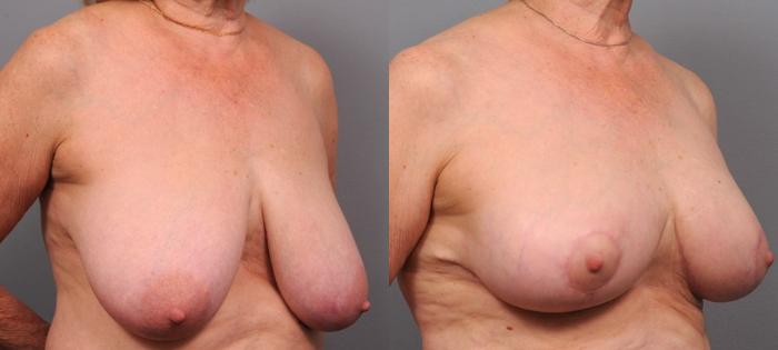 Before & After Breast Reduction Case 109 View #2 View in New York, NY