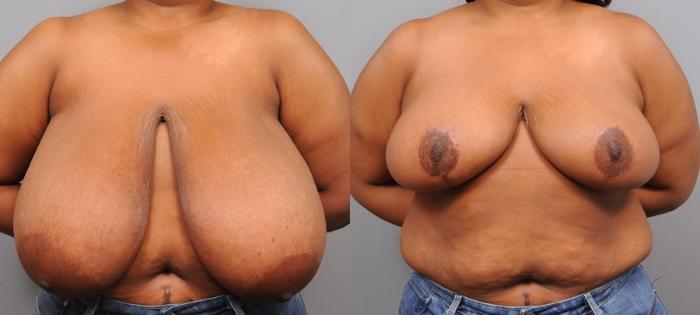 Before & After Breast Reduction Case 110 View #1 View in New York, NY