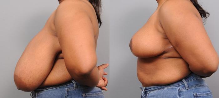 Before & After Breast Reduction Case 110 View #2 View in New York, NY