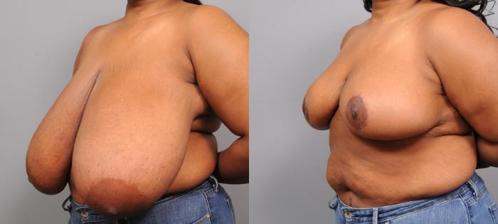 Before & After Breast Reduction Case 110 View #3 View in New York, NY