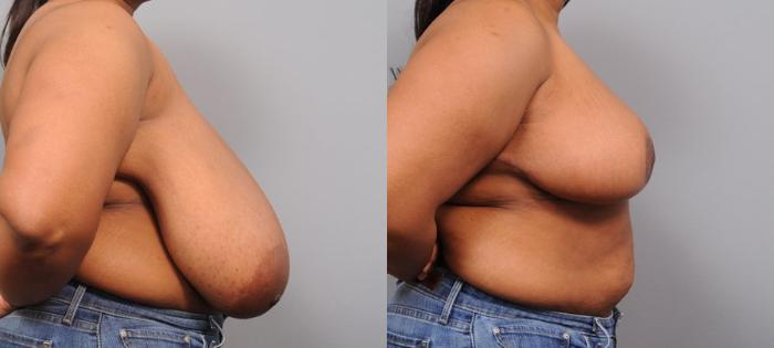 Before & After Breast Reduction Case 110 View #4 View in New York, NY