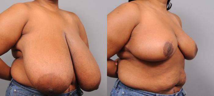Before & After Breast Reduction Case 110 View #5 View in New York, NY