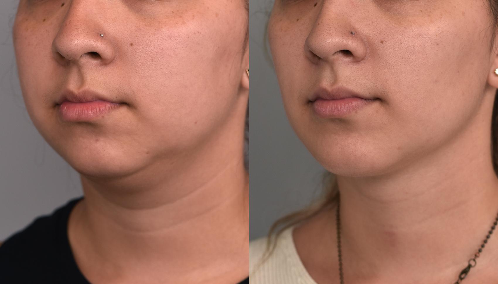 Before & After Buccal Fat Removal Case 225 View #1 View in New York, NY