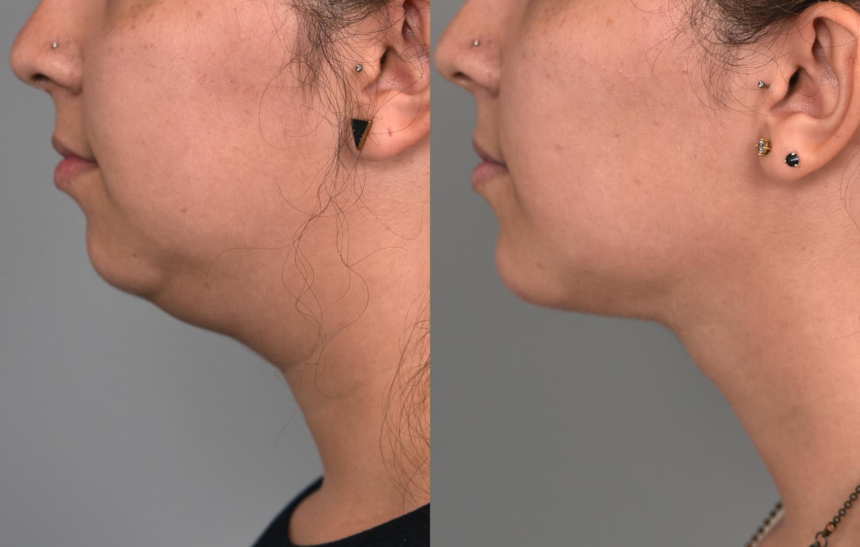 Before & After Cheek Liposuction Case 225 View #2 View in New York, NY