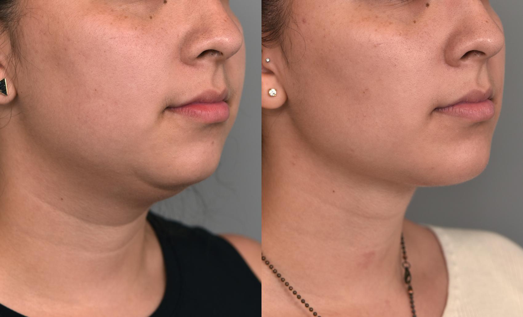 Before & After Buccal Fat Removal Case 225 View #3 View in New York, NY