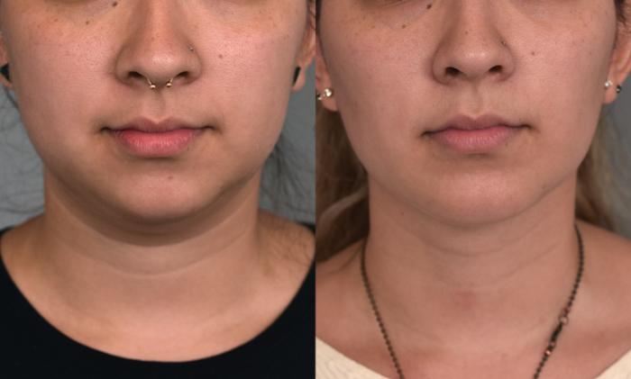 Before & After Cheek Liposuction Case 225 View #4 View in New York, NY