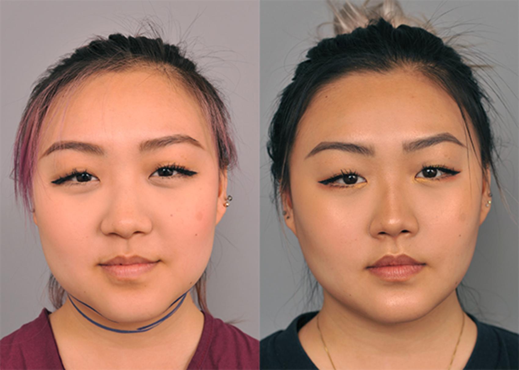 Uneven cheeks after buccal fat removal: why did this happen? (Photo)