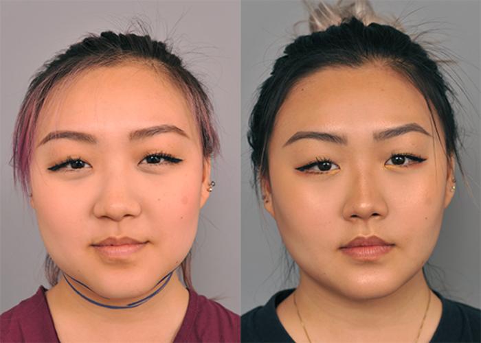Before & After Neck Liposuction / Chin Liposuction  Case 227 View #1 View in New York, NY