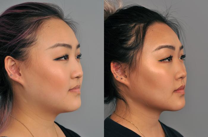 Before & After Buccal Fat Removal Case 227 View #2 View in New York, NY