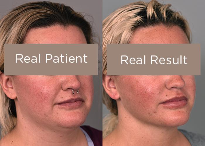 Before & After Buccal Fat Removal Case 228 View #1 View in New York, NY