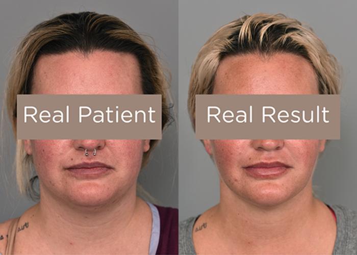 Before & After Buccal Fat Removal Case 228 View #2 View in New York, NY
