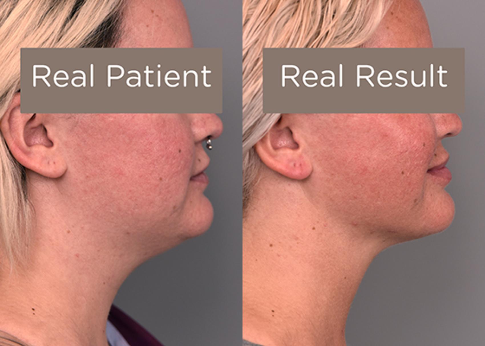 Before & After Buccal Fat Removal Case 228 View #3 View in New York, NY