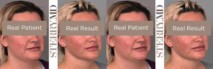 Before & After Buccal Fat Removal Case 228 View #4 View in New York, NY