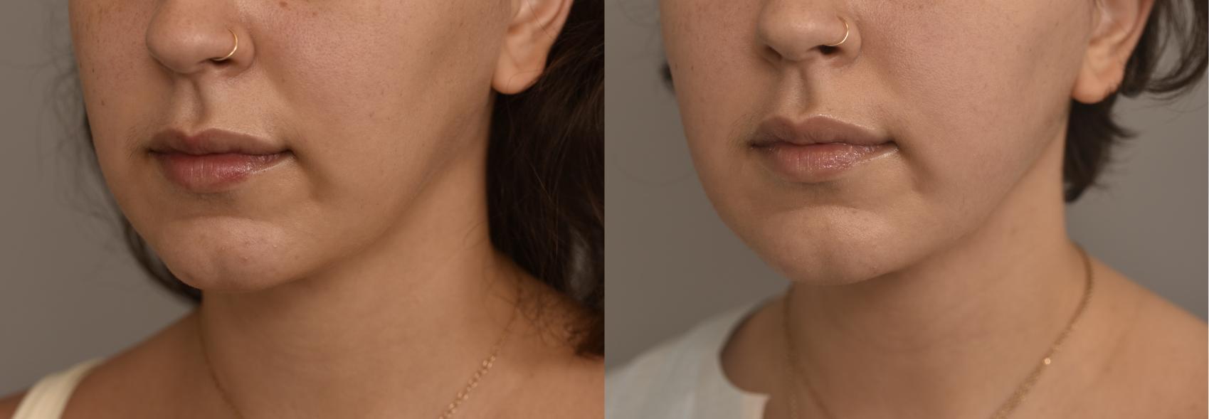 Before & After Buccal Fat Removal Case 255 View #1 View in New York, NY