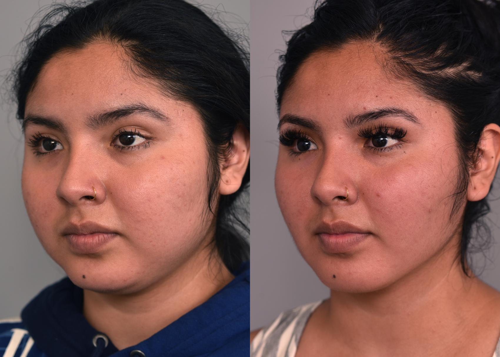 Before & After Cheek Liposuction Case 229 View #1 View in New York, NY