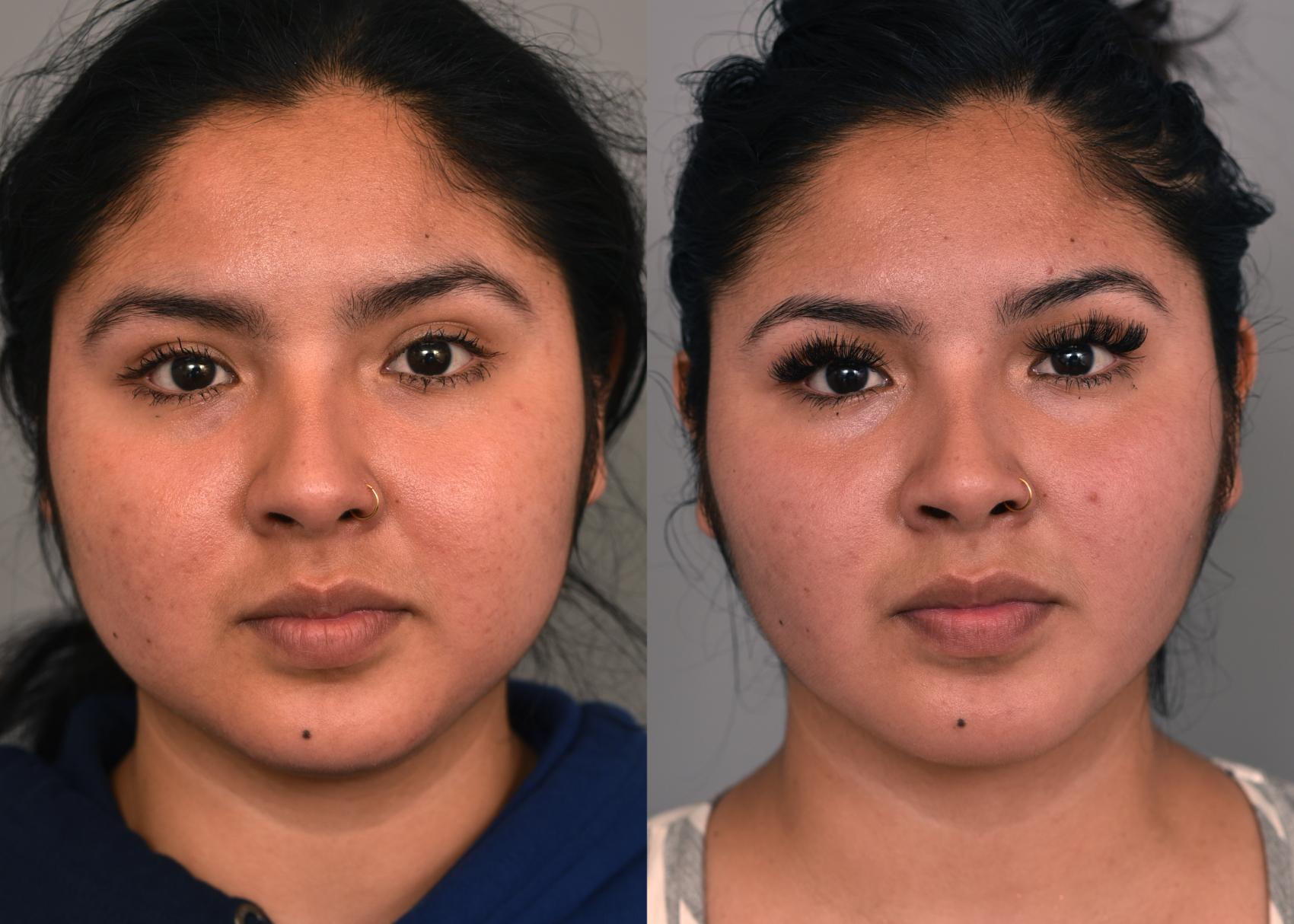 Before & After Cheek Liposuction Case 229 View #2 View in New York, NY