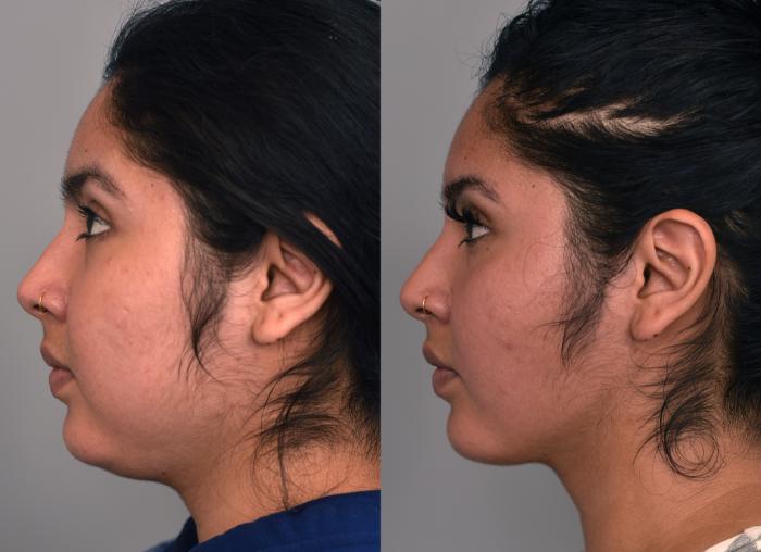 Before & After Cheek Liposuction Case 229 View #3 View in New York, NY
