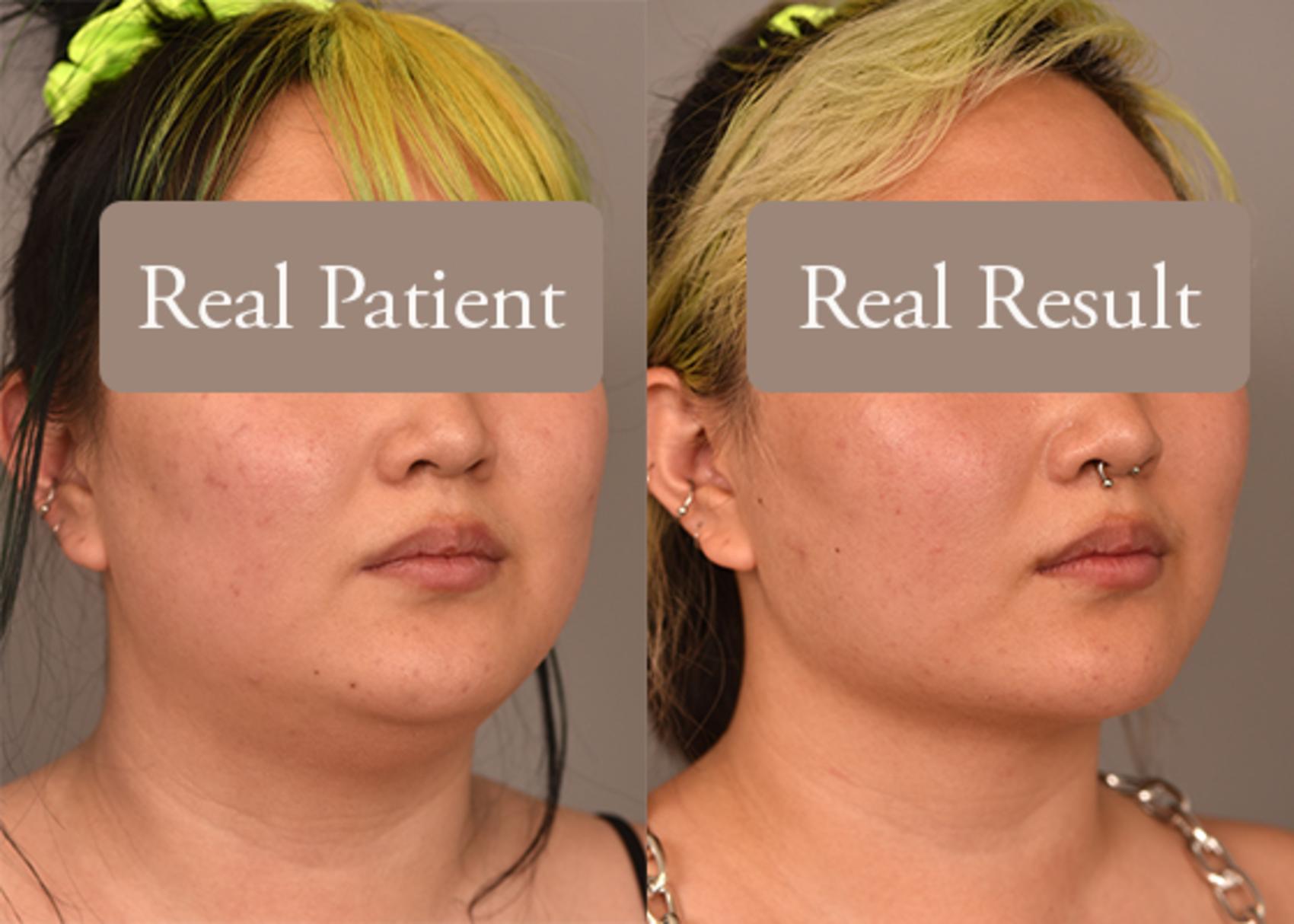 Before & After Cheek Liposuction Case 241 View #1 View in New York, NY