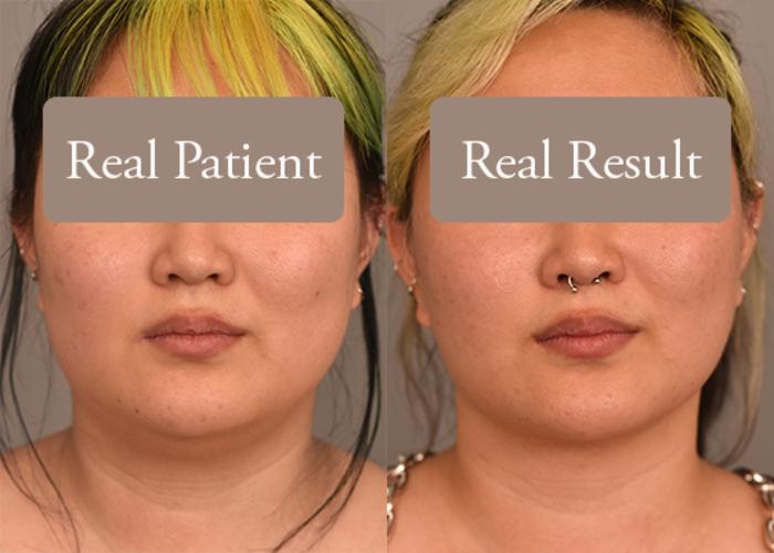 Before & After Neck Liposuction / Chin Liposuction  Case 241 View #2 View in New York, NY