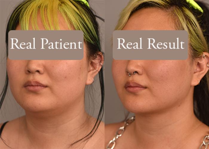 Before & After Cheek Liposuction Case 241 View #3 View in New York, NY