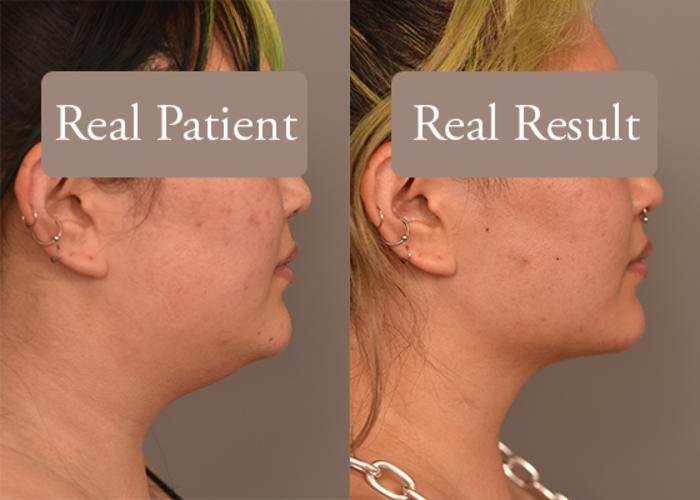 Before & After Neck Liposuction / Chin Liposuction  Case 241 View #4 View in New York, NY