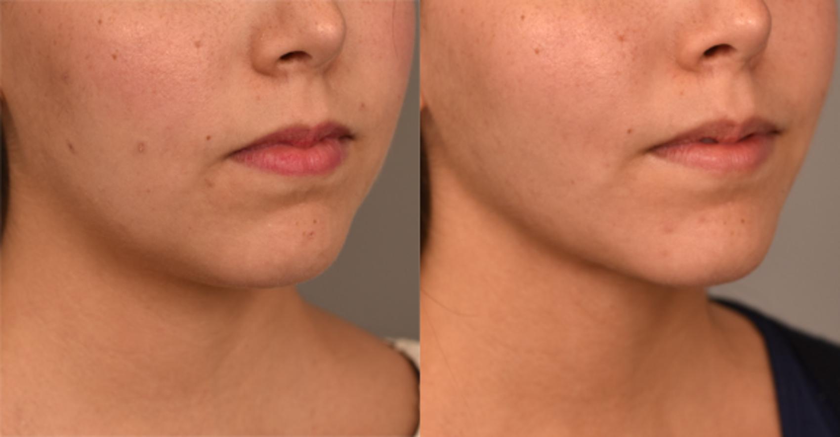 Before & After Cheek Liposuction Case 242 View #1 View in New York, NY