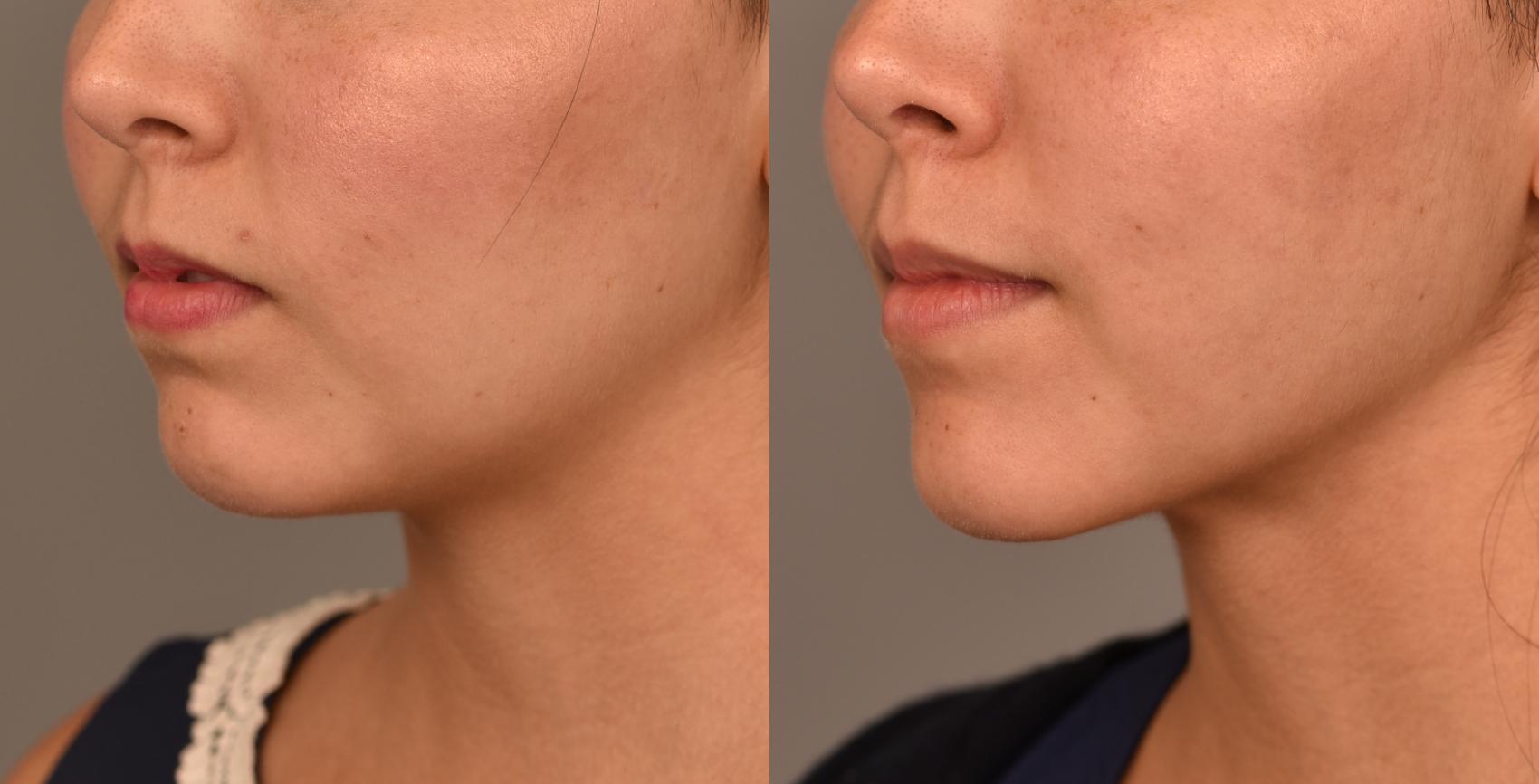 Before & After Cheek Liposuction Case 242 View #2 View in New York, NY