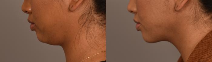 Before & After Cheek Liposuction Case 250 View #1 View in New York, NY