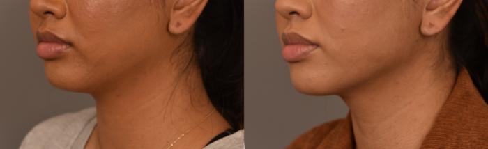 Before & After Cheek Liposuction Case 250 View #2 View in New York, NY
