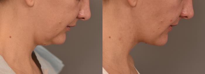 Before & After Cheek Liposuction Case 253 View #1 View in New York, NY