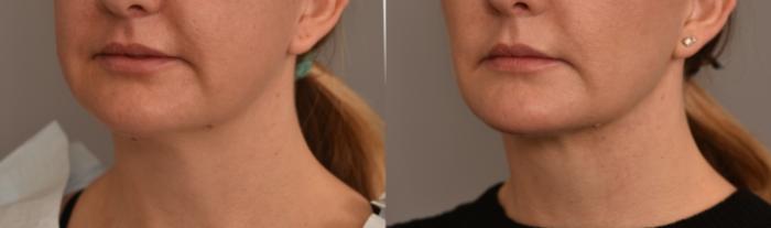 Before & After Cheek Liposuction Case 253 View #2 View in New York, NY