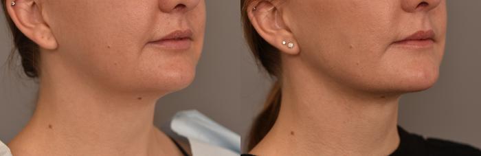 Before & After Cheek Liposuction Case 253 View #4 View in New York, NY