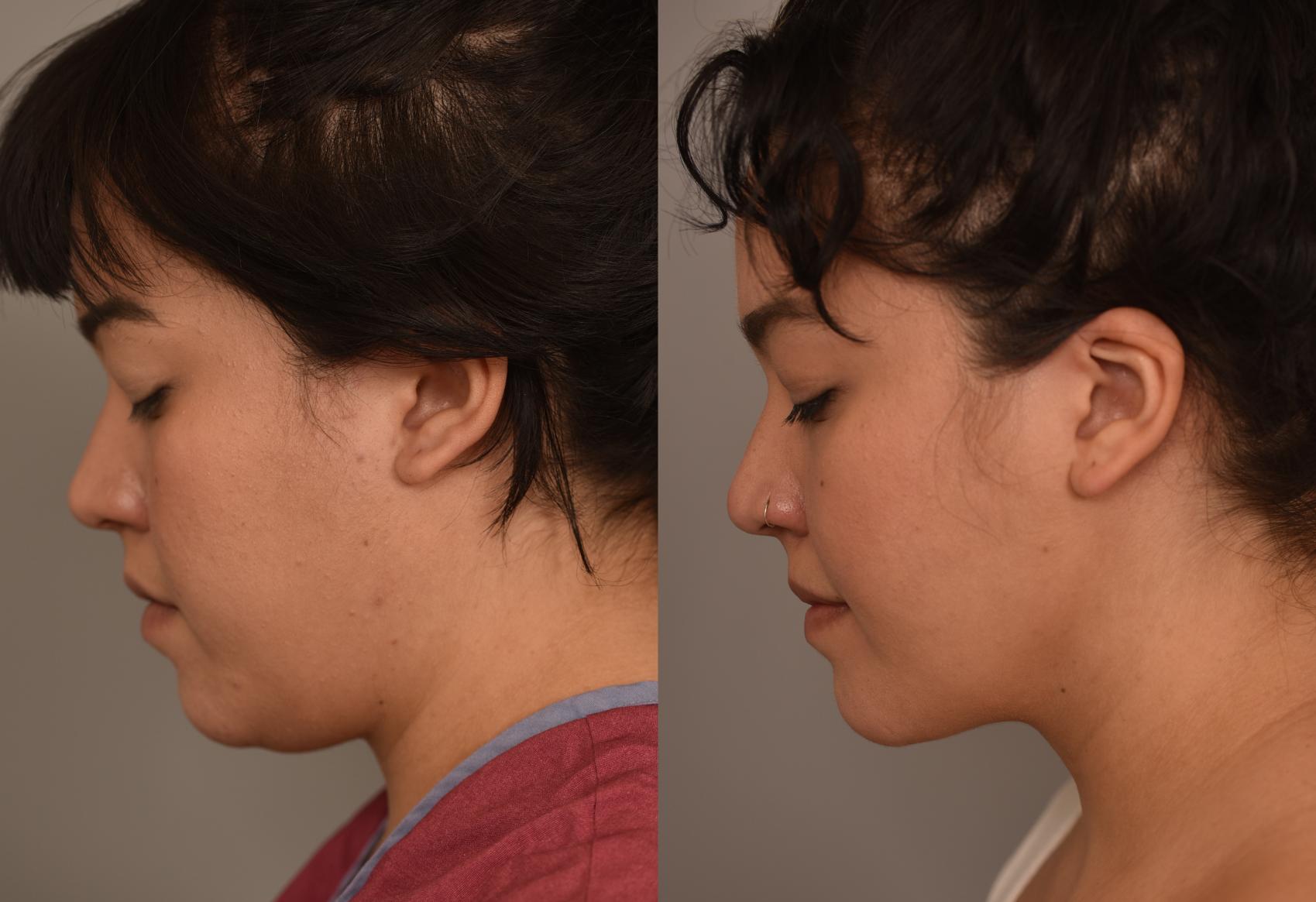 Before & After Cheek Liposuction Case 254 View #1 View in New York, NY