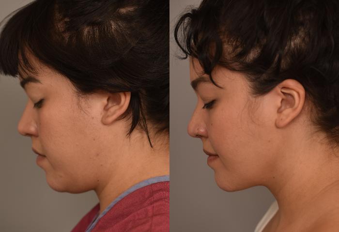Before & After Buccal Fat Removal Case 254 View #1 View in New York, NY