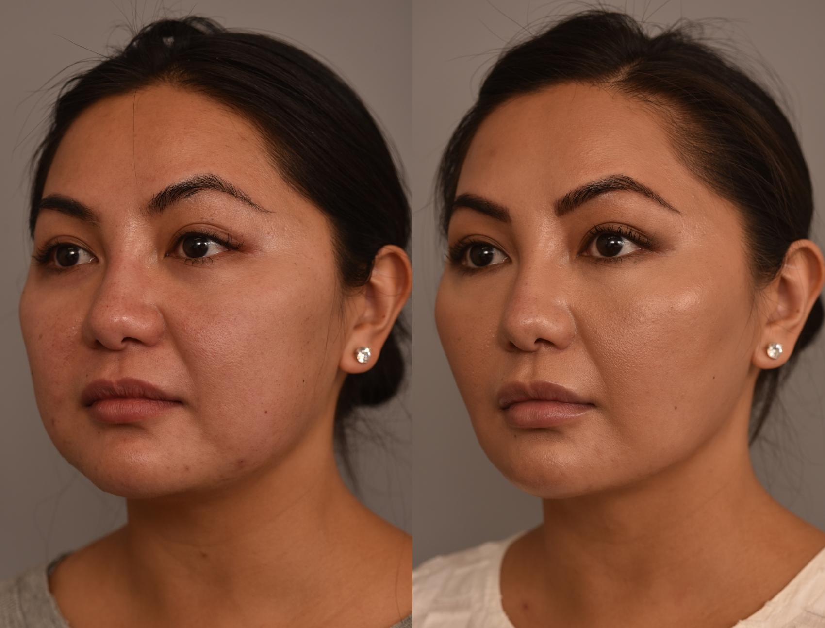 Before & After Cheek Liposuction Case 256 Front View in New York, NY