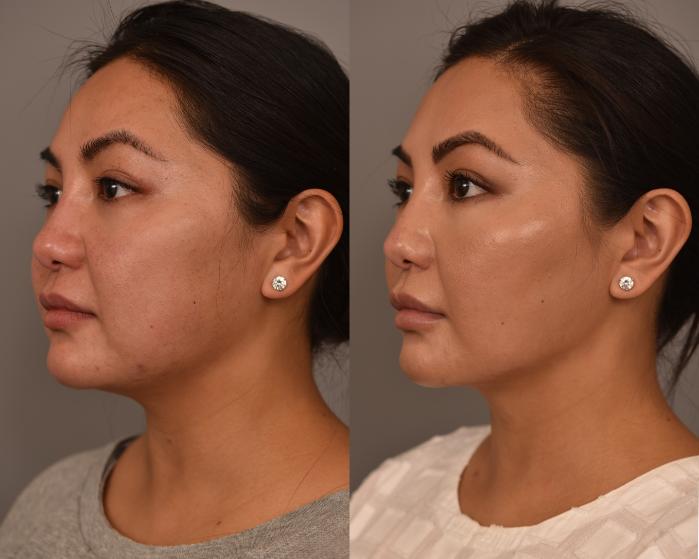 Before & After Cheek Liposuction Case 256 Left Oblique View in New York, NY