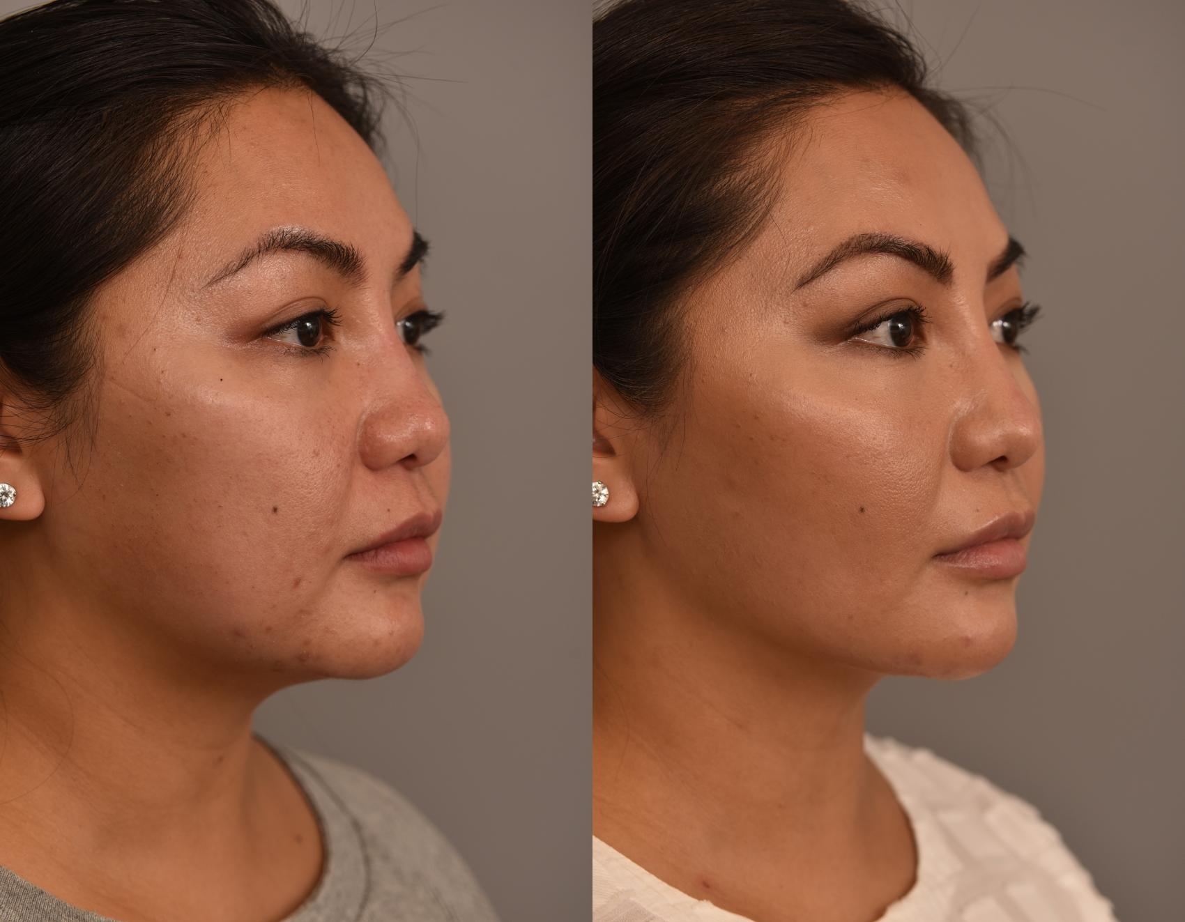 Before & After Cheek Liposuction Case 256 Right Oblique View in New York, NY