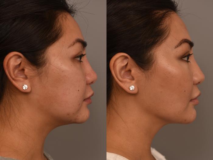 Before & After Cheek Liposuction Case 256 Right Side View in New York, NY