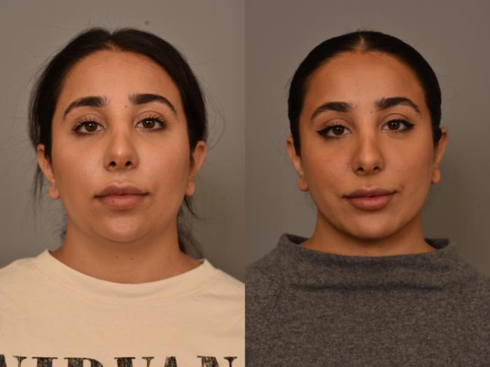 Before & After Chin Implant Case 295 Front View in New York, NY