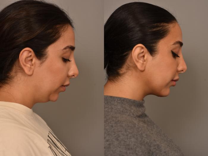 Before & After Chin Implant Case 295 Left Side Downward Gaze View in New York, NY