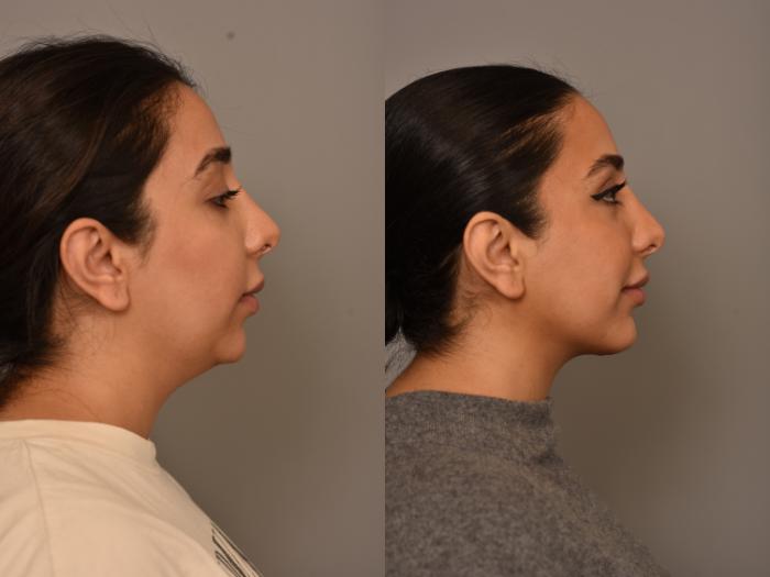 Before & After Chin Implant Case 295 Left Side View in New York, NY