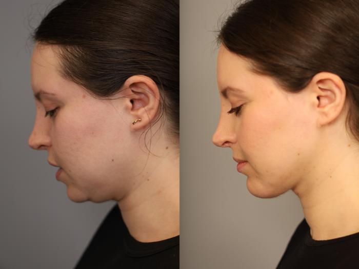Before & After Chin Implant Case 317 Left Oblique View in New York, NY