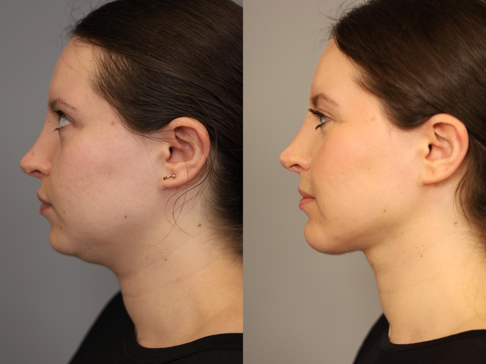 Before & After Chin Implant Case 317 Left Side View in New York, NY