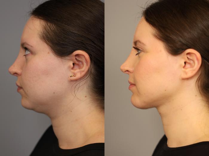 Before & After Chin Implant Case 317 Left Side View in New York, NY