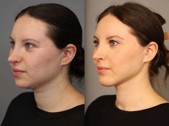 Before & After Chin Implant Case 317 Right Side View in New York, NY