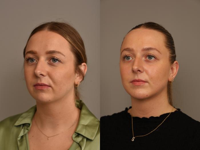 Before & After Chin Implant Case 318 Front View in New York, NY