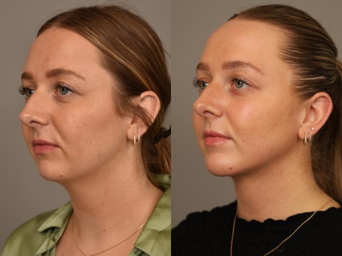 Before & After Chin Implant Case 318 Left Oblique View in New York, NY