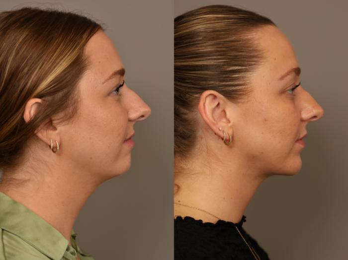 Before & After Chin Implant Case 318 Left Side View in New York, NY
